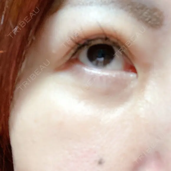 下まぶたの脂肪取り 湘南美容クリニック 千葉センシティ院 DAY 29 メイン用