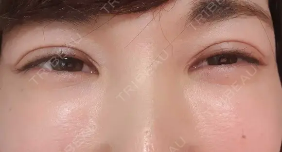 シワ取りボトックス 湘南美容クリニック 仙台院 DAY 54 メイン用