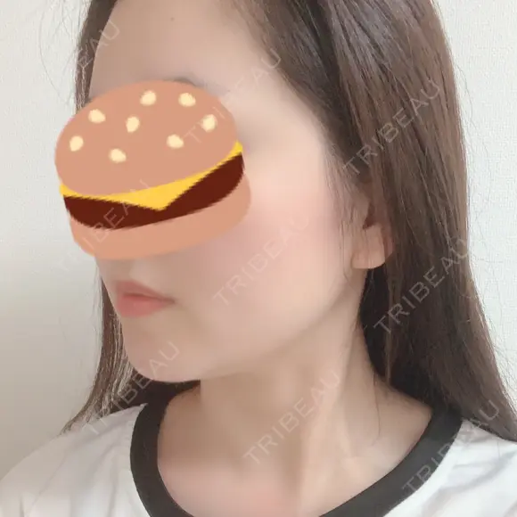 糸リフト / 骨切り（あご） / 骨削り（エラ） / 骨削り（頬） / 脂肪吸引（顔） RG整形外科（旧リオン整形外科） DAY 258 メイン用