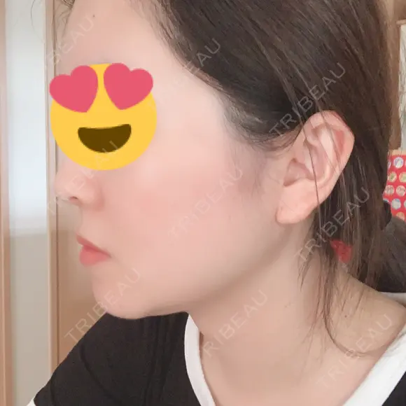 糸リフト / 骨切り（あご） / 骨削り（エラ） / 骨削り（頬） / 脂肪吸引（顔） RG整形外科（旧リオン整形外科） DAY 258 メイン用