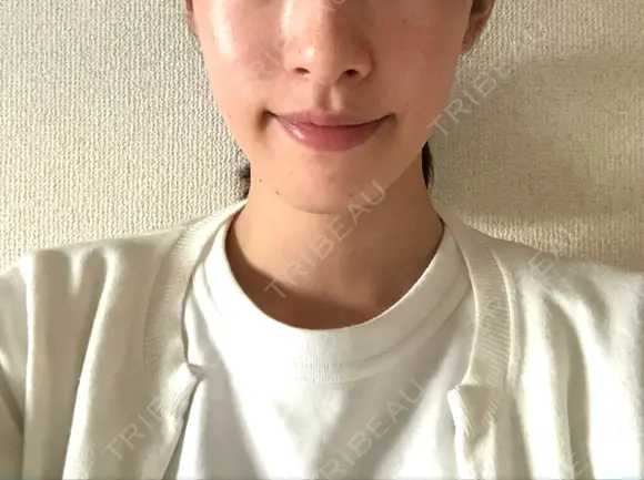脂肪溶解注射（顔） 銀座フェイスクリニック（小顔整形・輪郭整形專門） AFTER メイン用