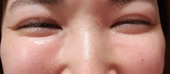 シワ取りボトックス 湘南美容クリニック 仙台院 AFTER メイン用