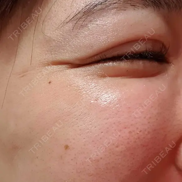 シワ取りボトックス 湘南美容クリニック 仙台院 DAY 56 メイン用