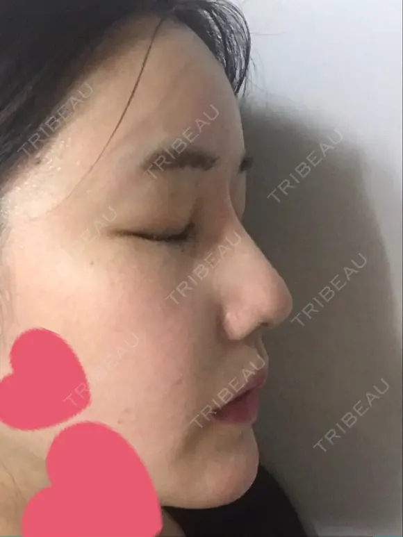 鼻尖形成（切開） / 骨切幅寄せ / ワシ鼻修正・ハンプ切除 / 眉間プロテーゼ ララ整形外科 DAY 224 メイン用