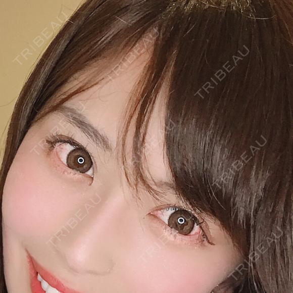 クマ治療 TCB東京中央美容外科 中野院 DAY 41 メイン用