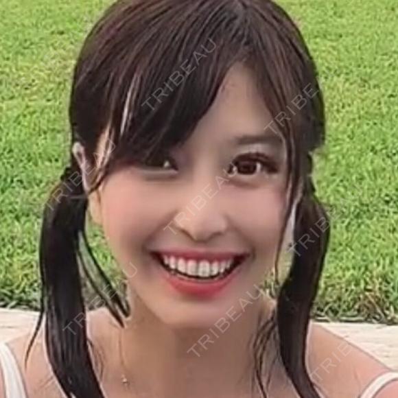 クマ治療 TCB東京中央美容外科 中野院 DAY 41 メイン用