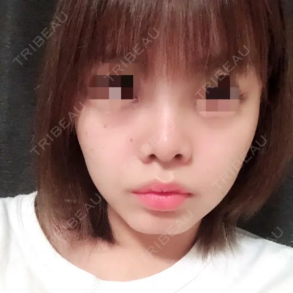 鼻尖形成（切開） / 小鼻縮小（切開） / 軟骨移植 / 眉間プロテーゼ 湘南美容クリニック 広島院 AFTER メイン用