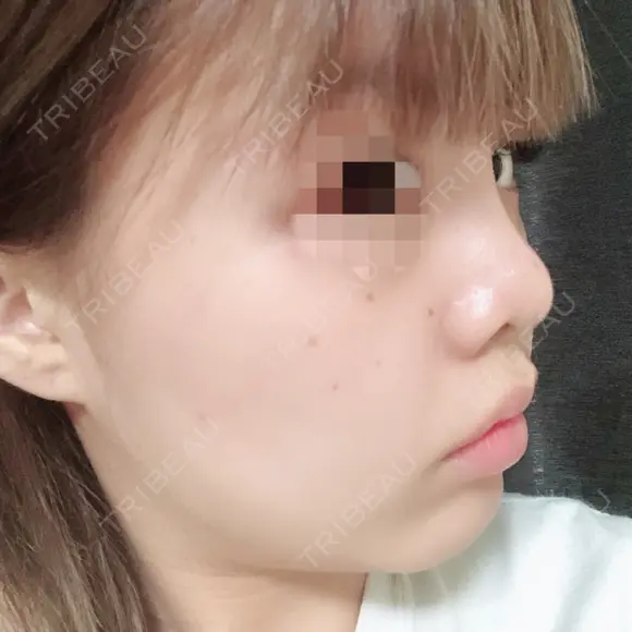 鼻尖形成（切開） / 小鼻縮小（切開） / 軟骨移植 / 眉間プロテーゼ 湘南美容クリニック 広島院 DAY 75 メイン用