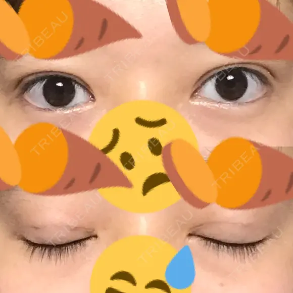 二重埋没 / 自然癒着法 表参道スキンクリニック 名古屋院（DAILY SKIN CLINIC提携院） DAY 16 メイン用