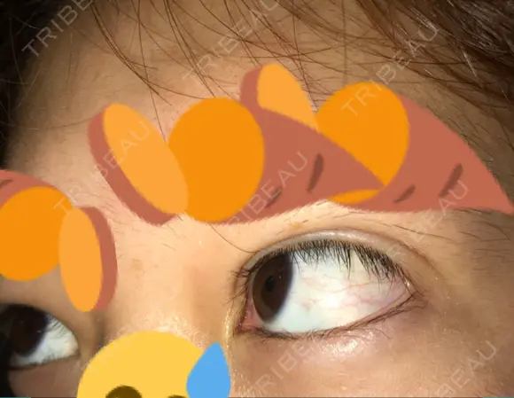 二重埋没 / 自然癒着法 表参道スキンクリニック 名古屋院（DAILY SKIN CLINIC提携院） DAY 16 メイン用