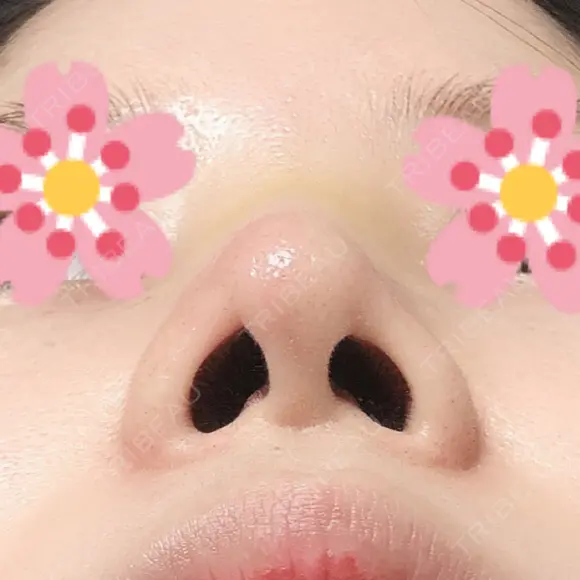 鼻尖形成（切開） / ヒアルロン酸注入（鼻） 東京ヒルズクリニック 新宿院 DAY 4 メイン用