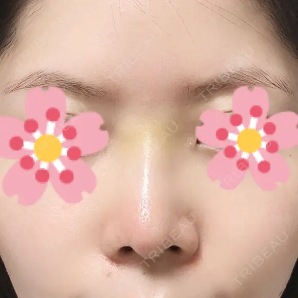 鼻尖形成（切開） / ヒアルロン酸注入（鼻） 東京ヒルズクリニック 新宿院 DAY 4 メイン用