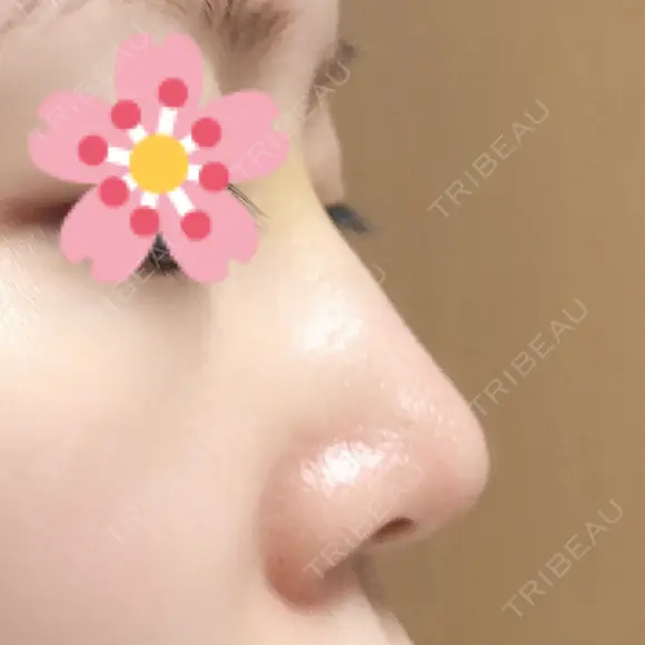 鼻尖形成（切開） / ヒアルロン酸注入（鼻） 東京ヒルズクリニック 新宿院 DAY 4 メイン用