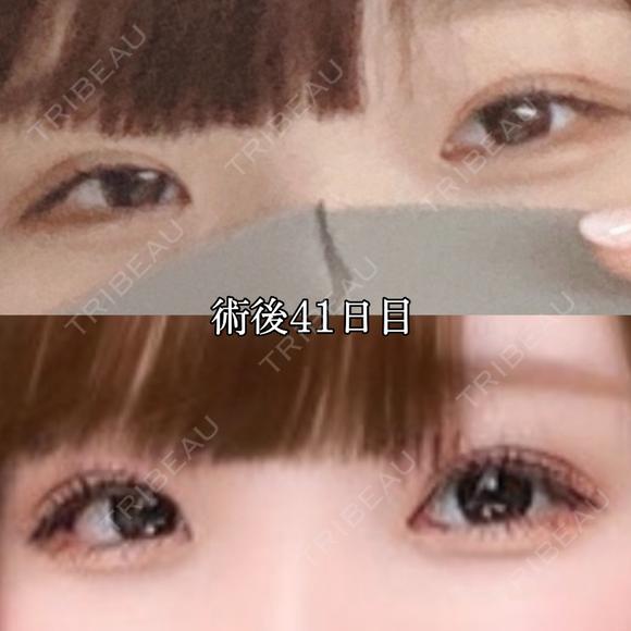 二重埋没 湘南美容クリニック 赤坂見附院 DAY 42 メイン用