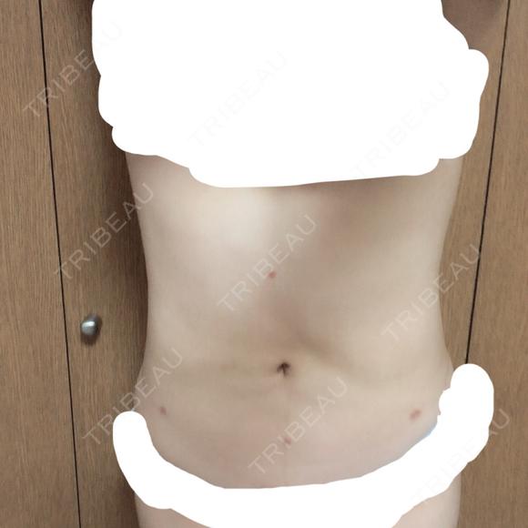 脂肪吸引（お腹） 石倉クリニック 水戸院 DAY 93 メイン用