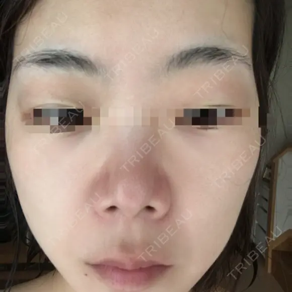 ハイフ（顔） 共立美容外科 仙台院 DAY 3 メイン用