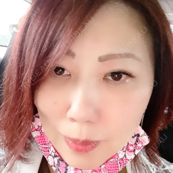 下まぶたの脂肪取り 湘南美容クリニック 千葉センシティ院 AFTER メイン用