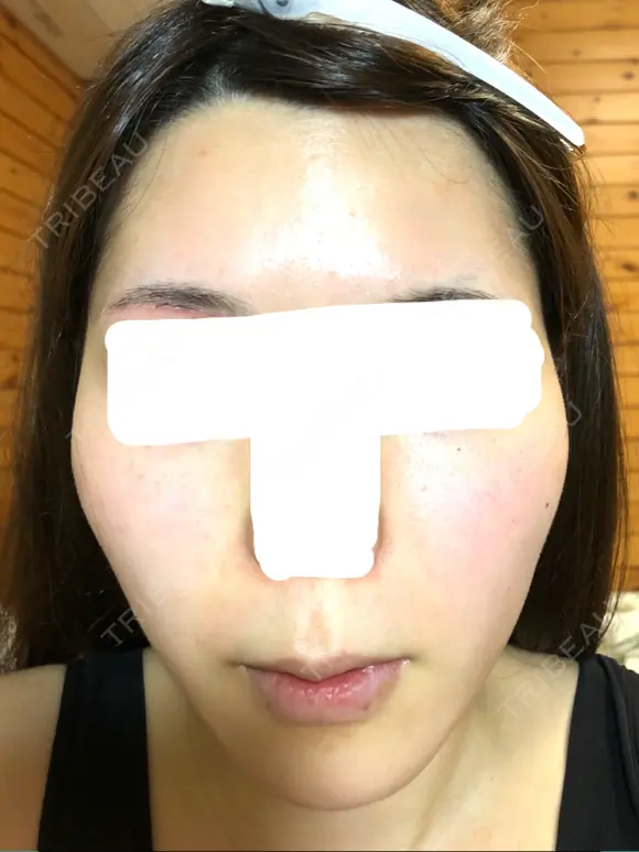 糸リフト / バッカルファット除去 / 脂肪吸引（顔） / ボトックス（エラ・小顔） 湘南美容クリニック 秋葉原院 DAY 59 メイン用