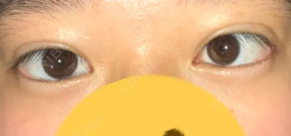 二重埋没 / 自然癒着法 表参道スキンクリニック 名古屋院（DAILY SKIN CLINIC提携院） DAY 17 メイン用