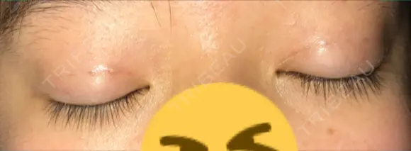 二重埋没 / 自然癒着法 表参道スキンクリニック 名古屋院（DAILY SKIN CLINIC提携院） DAY 17 メイン用