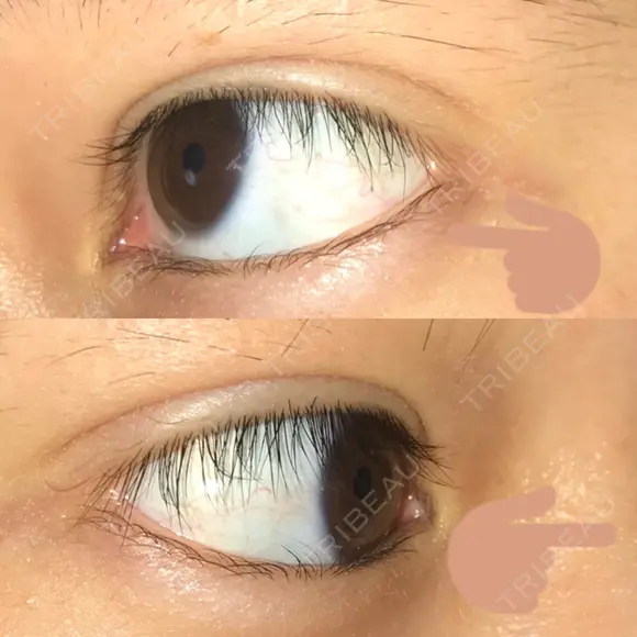 二重埋没 / 自然癒着法 表参道スキンクリニック 名古屋院（DAILY SKIN CLINIC提携院） DAY 17 メイン用