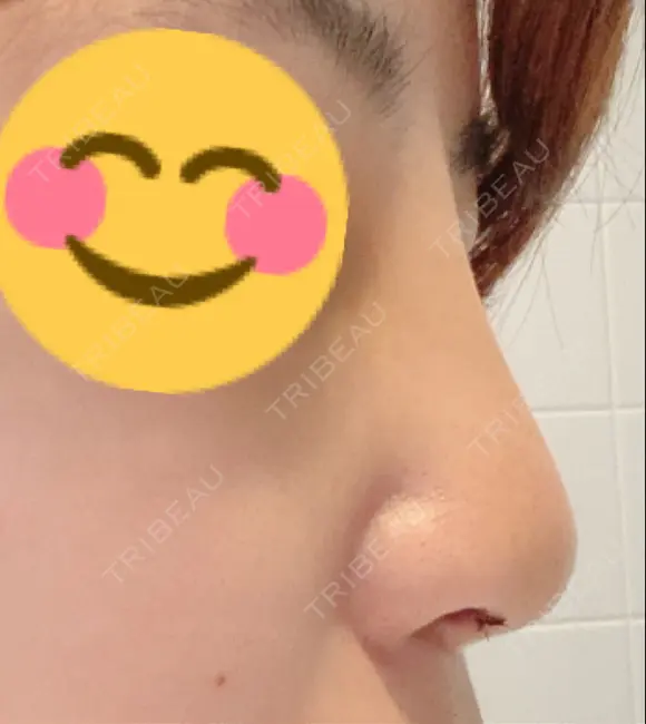 隆鼻術 たにまちクリニック DAY 4 メイン用
