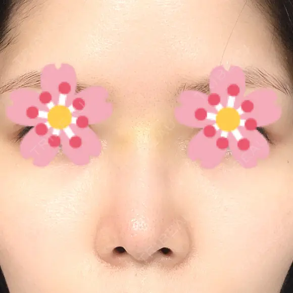 鼻尖形成（切開） / ヒアルロン酸注入（鼻） 東京ヒルズクリニック 新宿院 DAY 6 メイン用