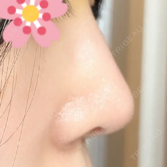 鼻尖形成（切開） / ヒアルロン酸注入（鼻） 東京ヒルズクリニック 新宿院 DAY 6 メイン用