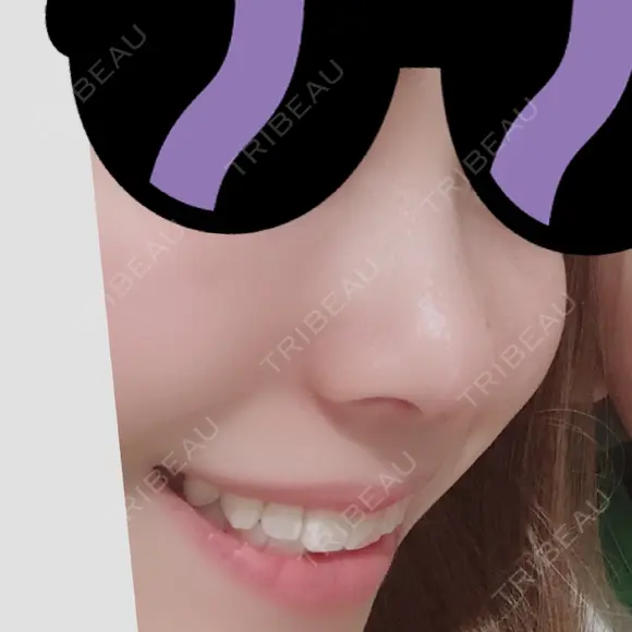 鼻尖形成（切開） / 小鼻縮小（切開） / 軟骨移植 湘南美容クリニック 船橋院 DAY 35 メイン用