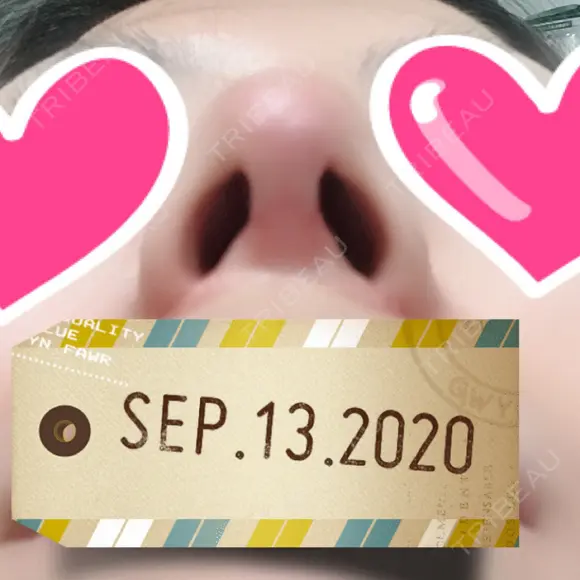 鼻尖形成（切開） / 小鼻縮小（切開） / 軟骨移植 湘南美容クリニック 船橋院 DAY 35 メイン用