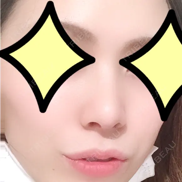 鼻尖形成（切開） / 小鼻縮小（切開） / 軟骨移植 湘南美容クリニック 船橋院 DAY 35 メイン用