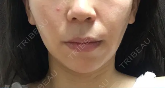 バッカルファット除去 / 脂肪吸引（顔） 湘南美容クリニック 那覇院 DAY 111 メイン用