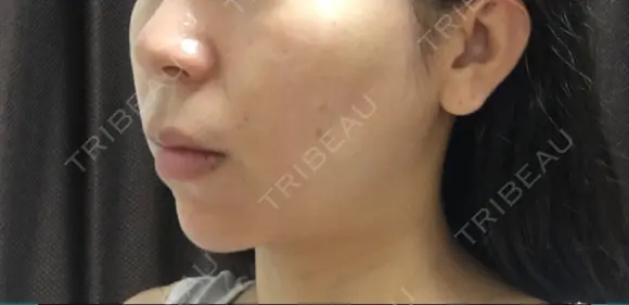 バッカルファット除去 / 脂肪吸引（顔） 湘南美容クリニック 那覇院 DAY 111 メイン用