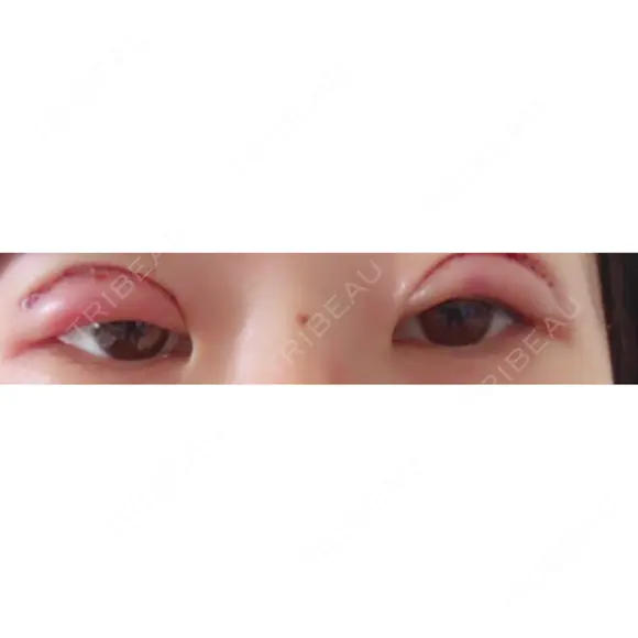 眼瞼下垂（切開） リビジョンクリニック（旧：池本形成外科・美容外科） DAY 0 メイン用