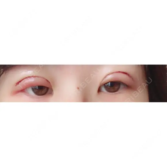 眼瞼下垂（切開） リビジョンクリニック（旧：池本形成外科・美容外科） DAY 1 メイン用