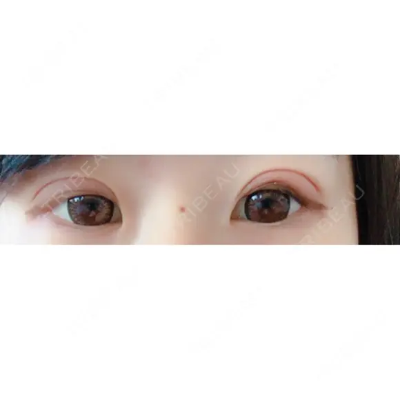 眼瞼下垂（切開） リビジョンクリニック（旧：池本形成外科・美容外科） DAY 17 メイン用
