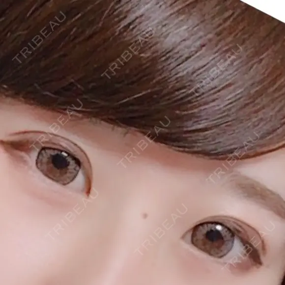 眼瞼下垂（切開） リビジョンクリニック（旧：池本形成外科・美容外科） AFTER メイン用