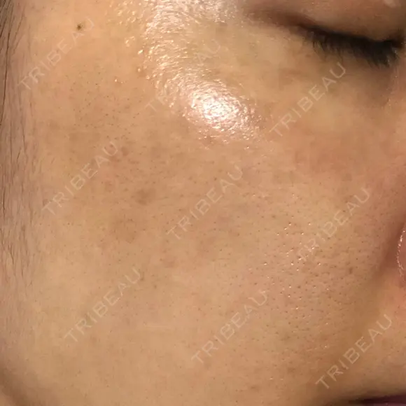 シミ取りレーザー / YAGレーザー 仁愛クリニック DAY 104 メイン用