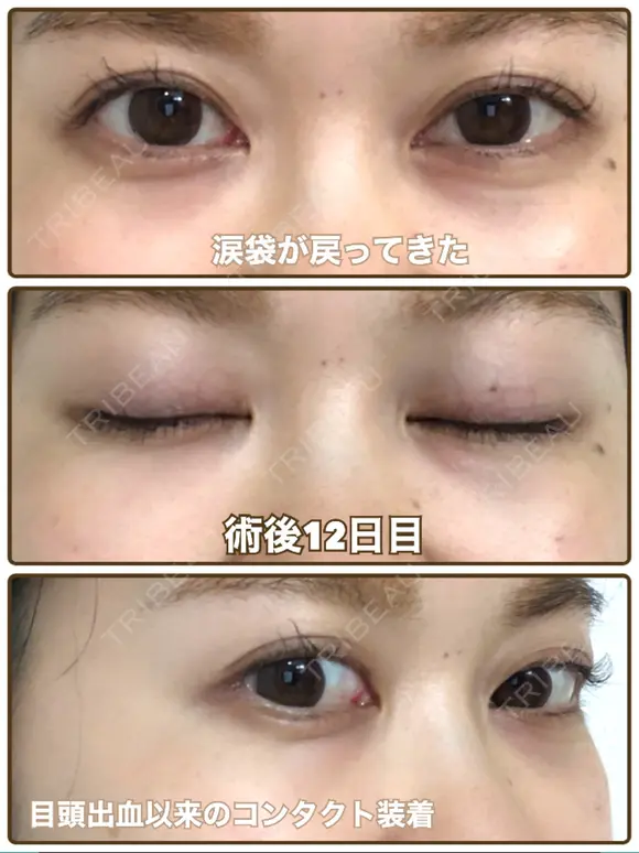 クマ治療 / 脂肪吸引（脚） / 下まぶたたるみ取り / 下まぶたの脂肪取り 湘南美容クリニック 千葉センシティ院 AFTER メイン用