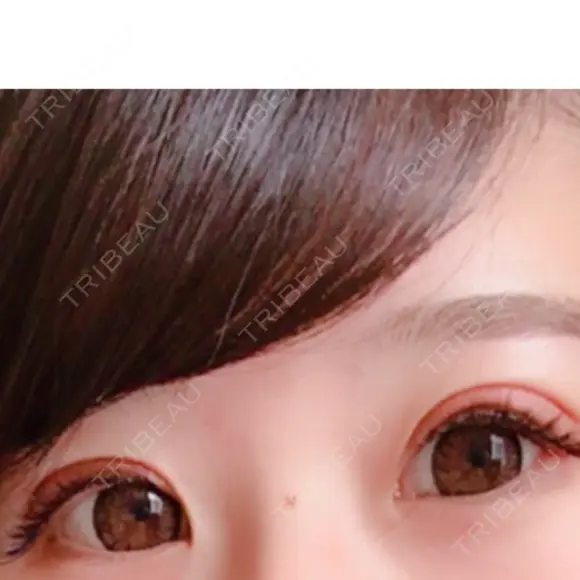 眼瞼下垂（切開） リビジョンクリニック（旧：池本形成外科・美容外科） DAY 21 メイン用