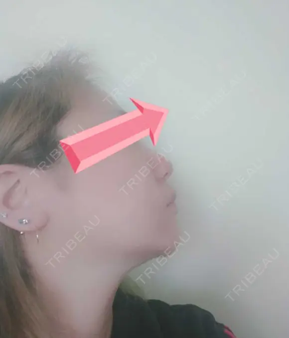 糸リフト / レディエッセ注入（鼻） トアロード形成美容クリニック DAY 32 メイン用