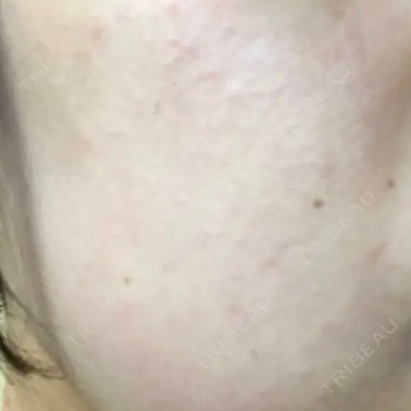 ピーリング（ニキビ・毛穴） 自由が丘クリニック DAY 1 メイン用