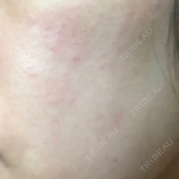 ピーリング（ニキビ・毛穴） 自由が丘クリニック DAY 1 メイン用