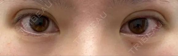 二重埋没 湘南美容クリニック 宇都宮院 DAY 0 メイン用