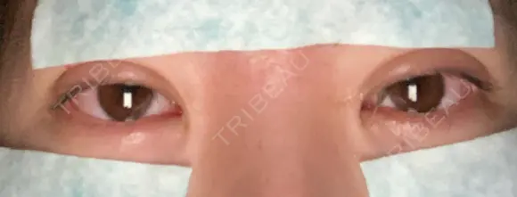 二重埋没 湘南美容クリニック 宇都宮院 DAY 1 メイン用