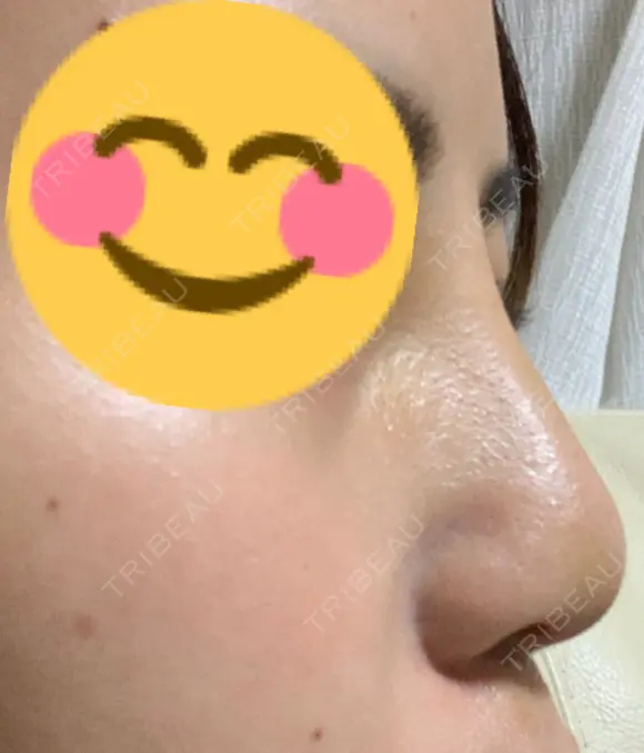 隆鼻術 たにまちクリニック DAY 8 メイン用