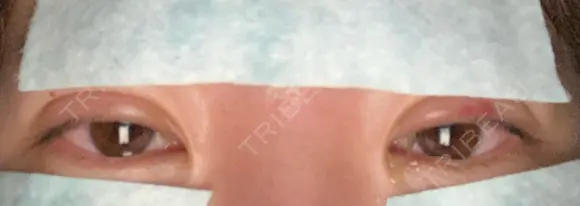 二重埋没 湘南美容クリニック 宇都宮院 DAY 2 メイン用