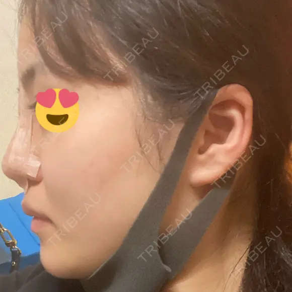 隆鼻術 湘南美容クリニック 岡山院 DAY 0 メイン用