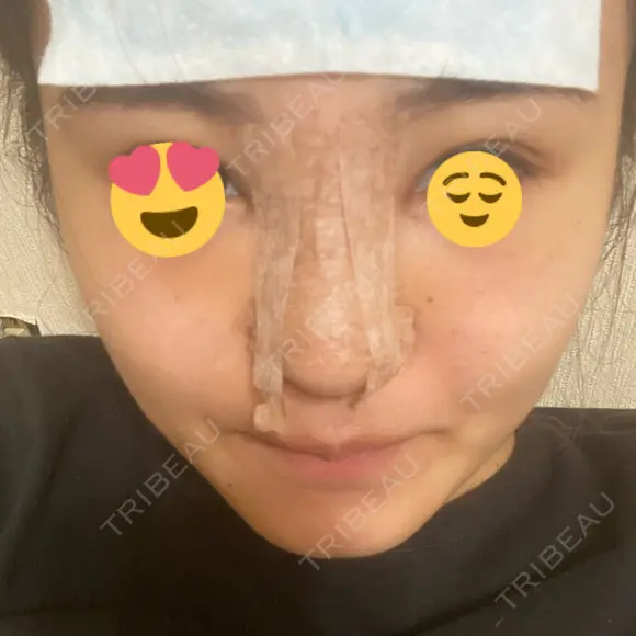 隆鼻術 湘南美容クリニック 岡山院 AFTER メイン用