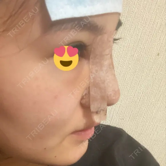 隆鼻術 湘南美容クリニック 岡山院 DAY 1 メイン用